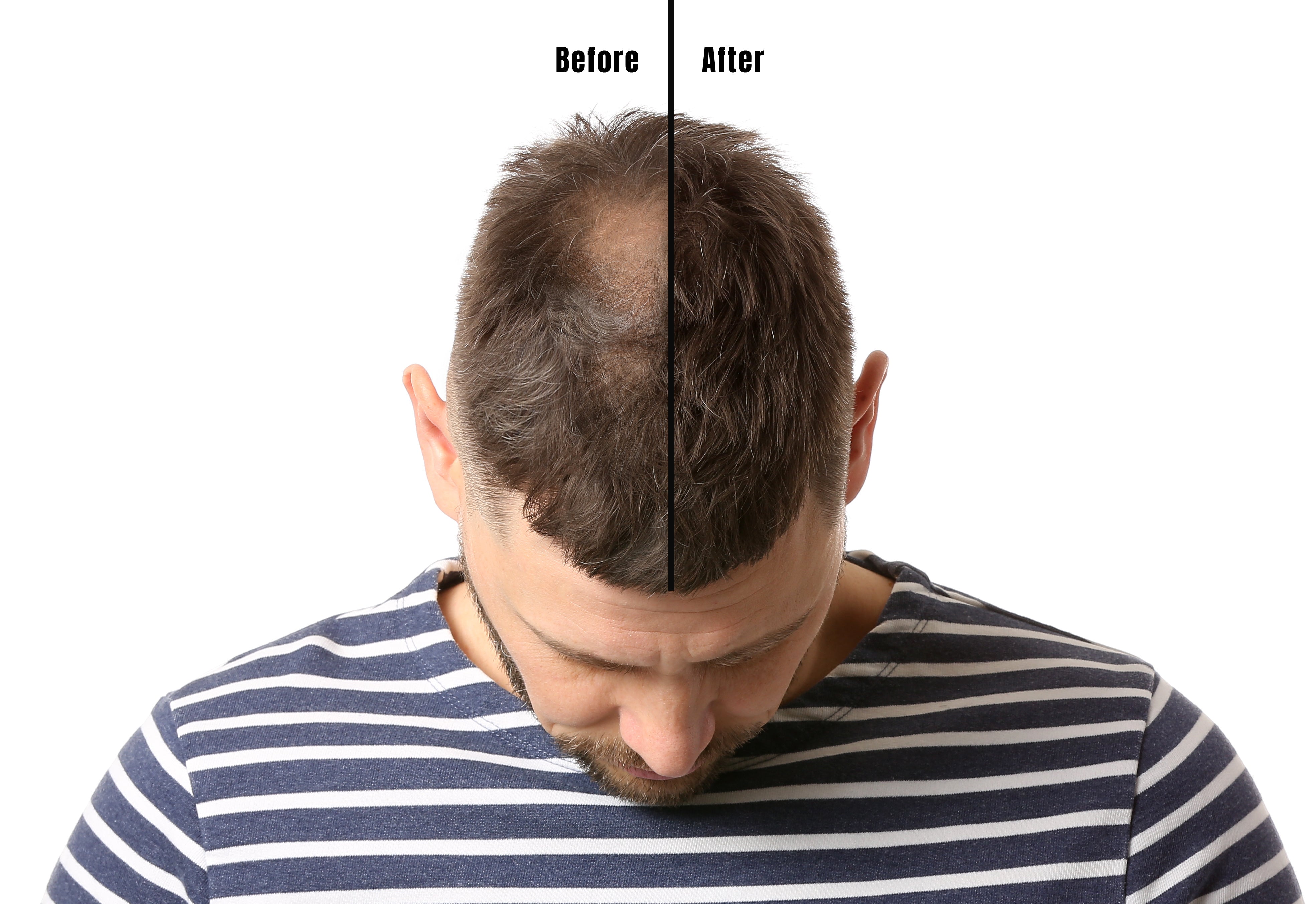 Hair Loss Solution: Phases in Male Pattern Baldness