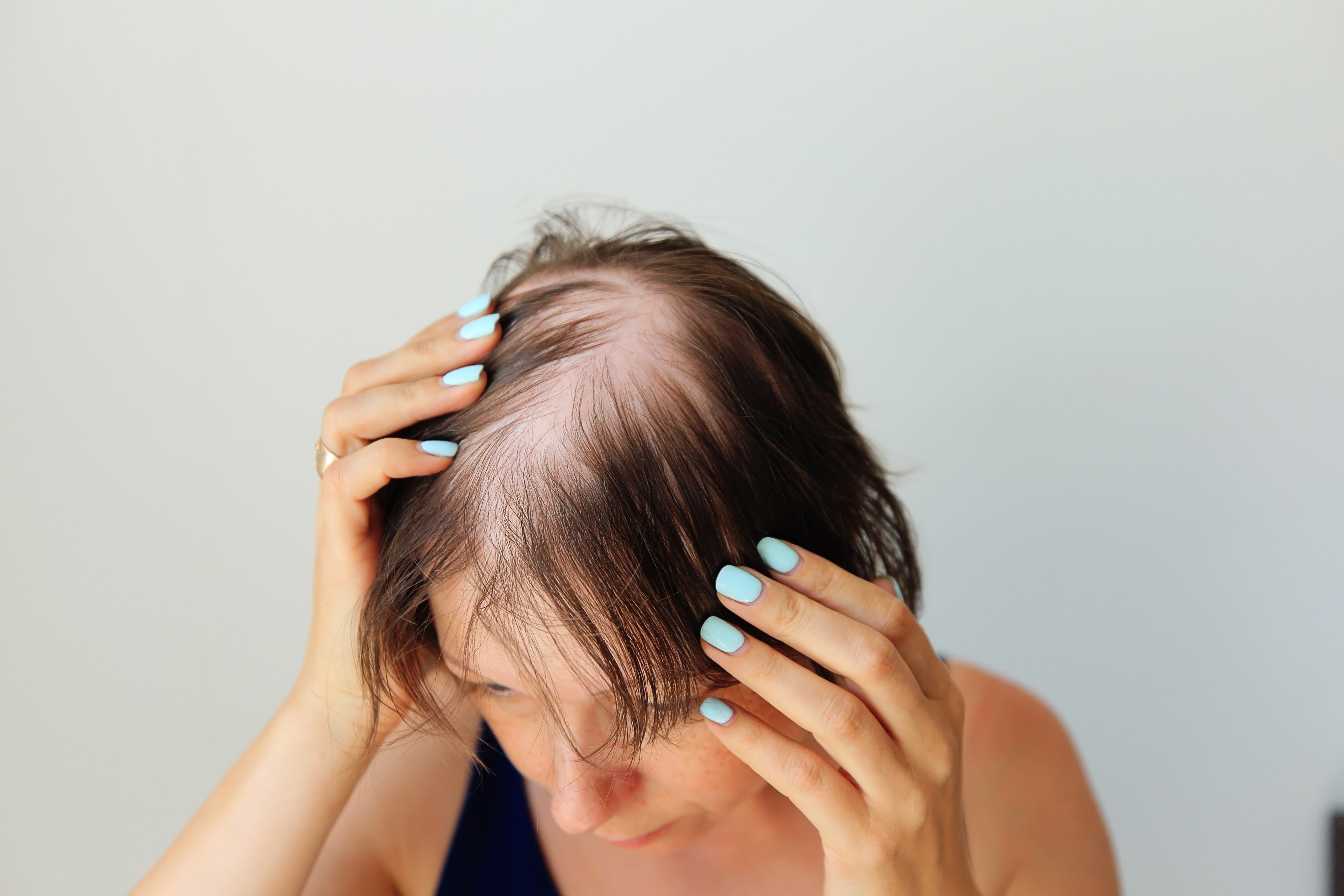 Hair Loss Solution: Fine and Thinning Hair Care for Women