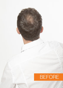 Hair Loss Prevention: Density Control Kit for Men