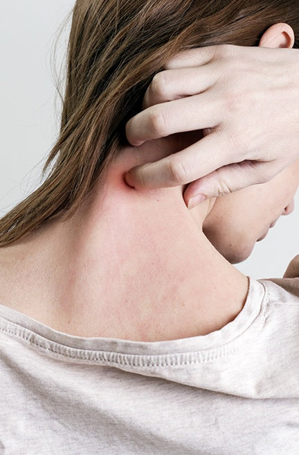 Hair Loss Solution : Eczema Scalp Condition