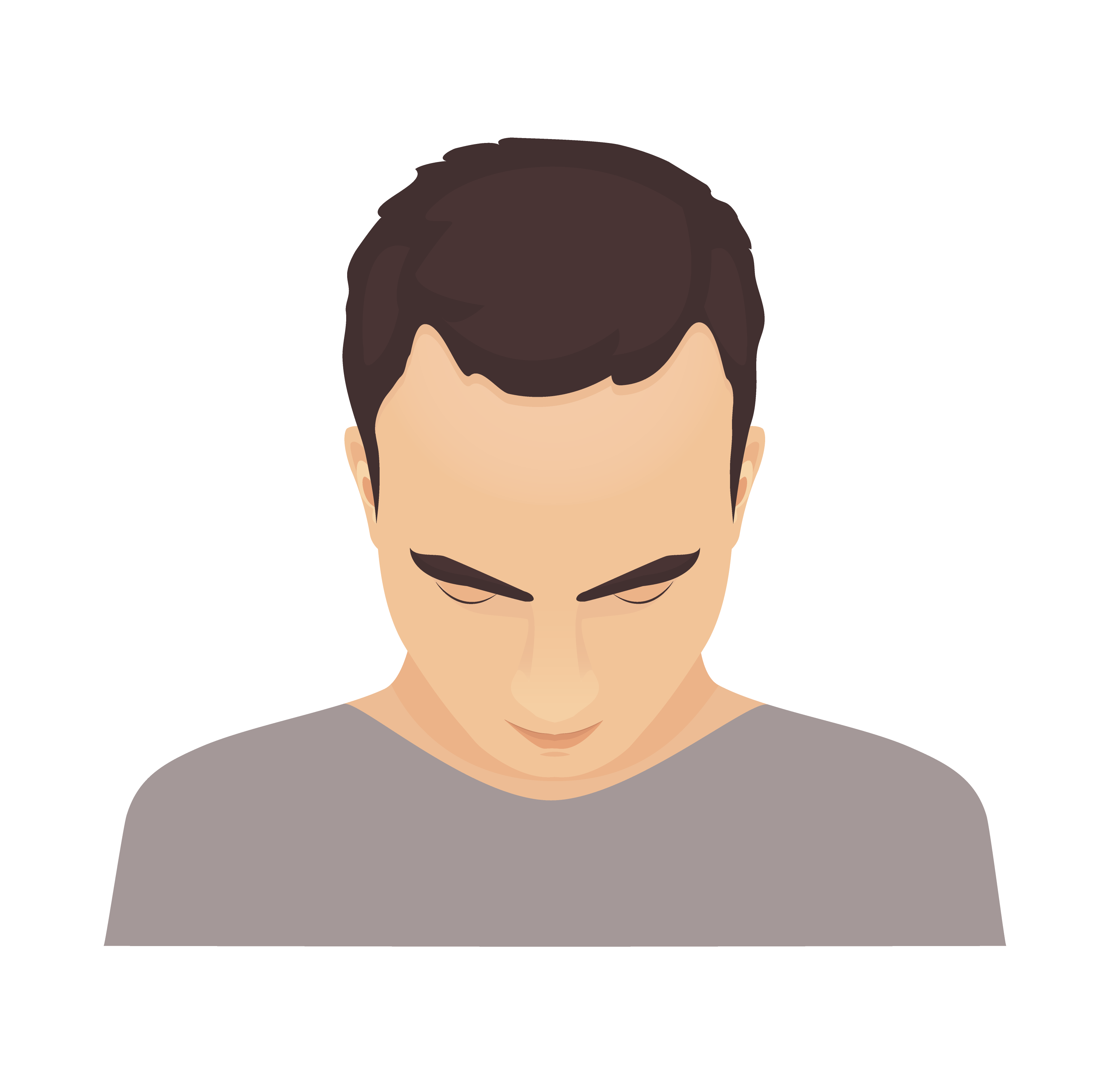 Hair Loss Solution: Phases in Male Pattern Baldness