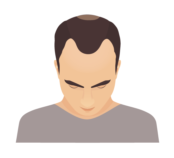 Hair Loss Solutions: Density Control Hair Care for Men
