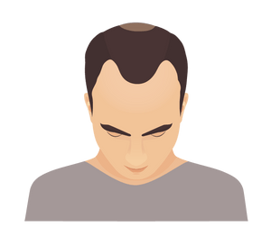 Hair Loss Solutions: Density Control Hair Care for Men